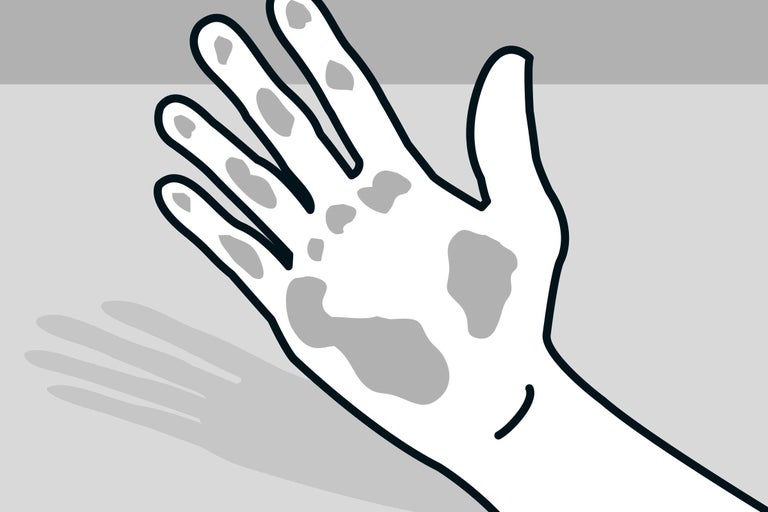 Hand mit Flecken